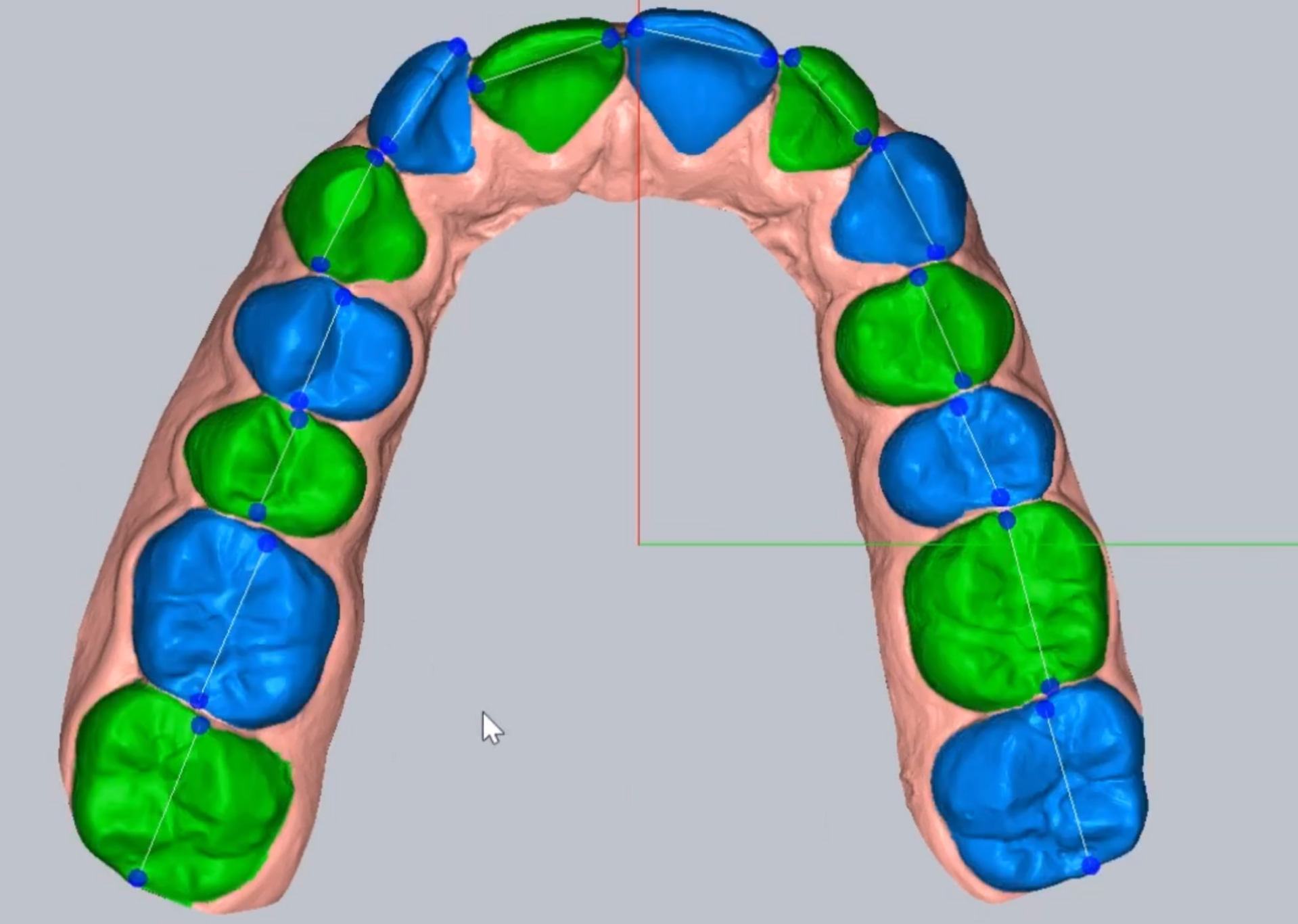 3D clear aligners on upper arch model with green-blue margins, fast CAD design services for US labs
