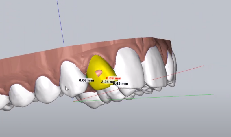 3d clear aligner cad cam project