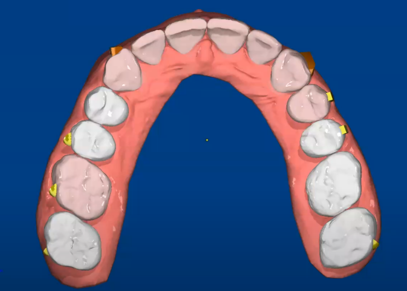 3d clear aligner cad cam project