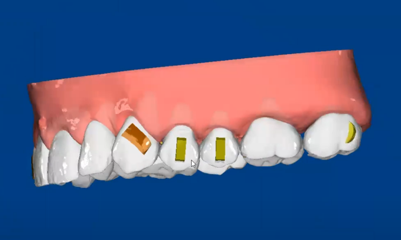 3d clear aligner cad cam project