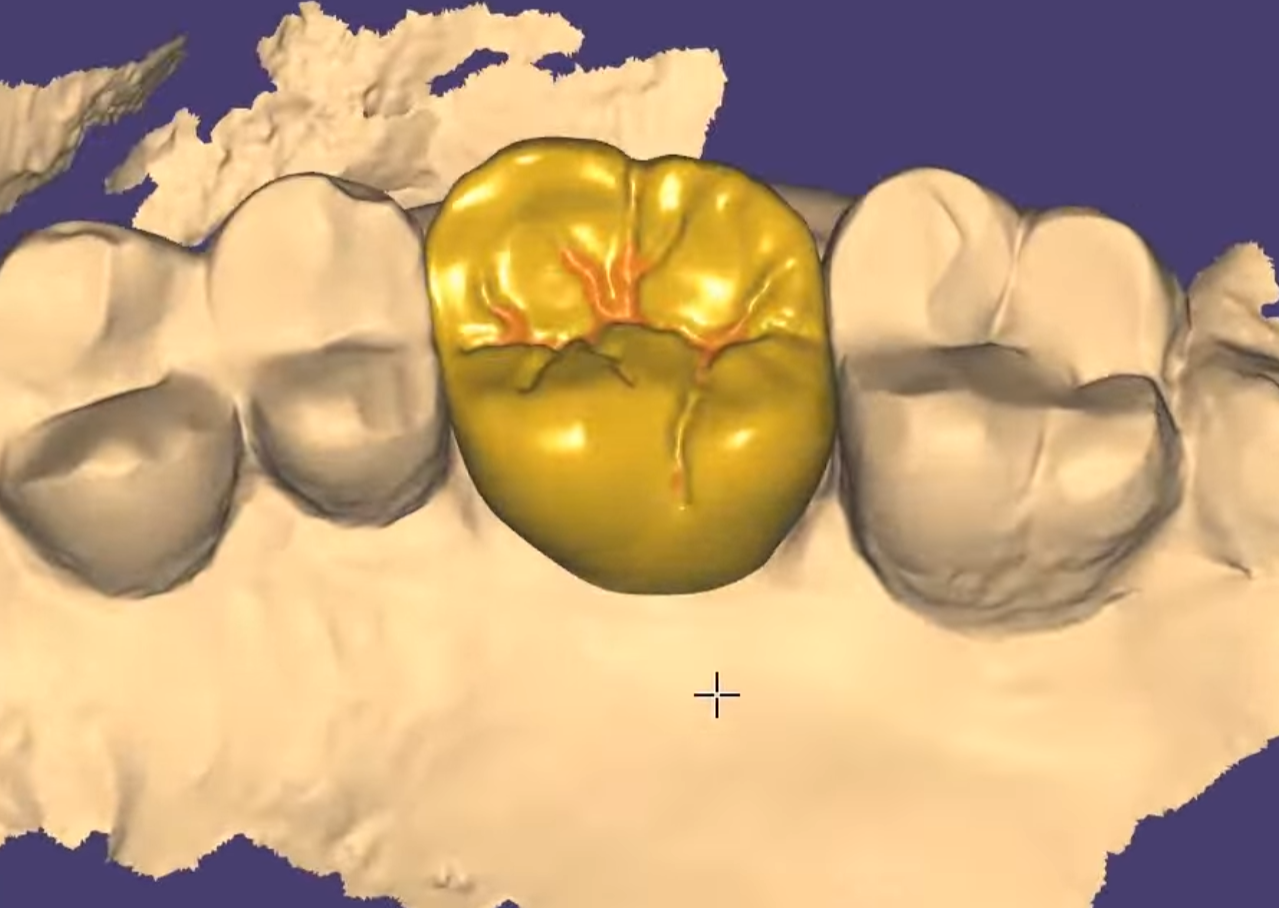3D Denral crown modeled tooth,  CAD design example for dental labs