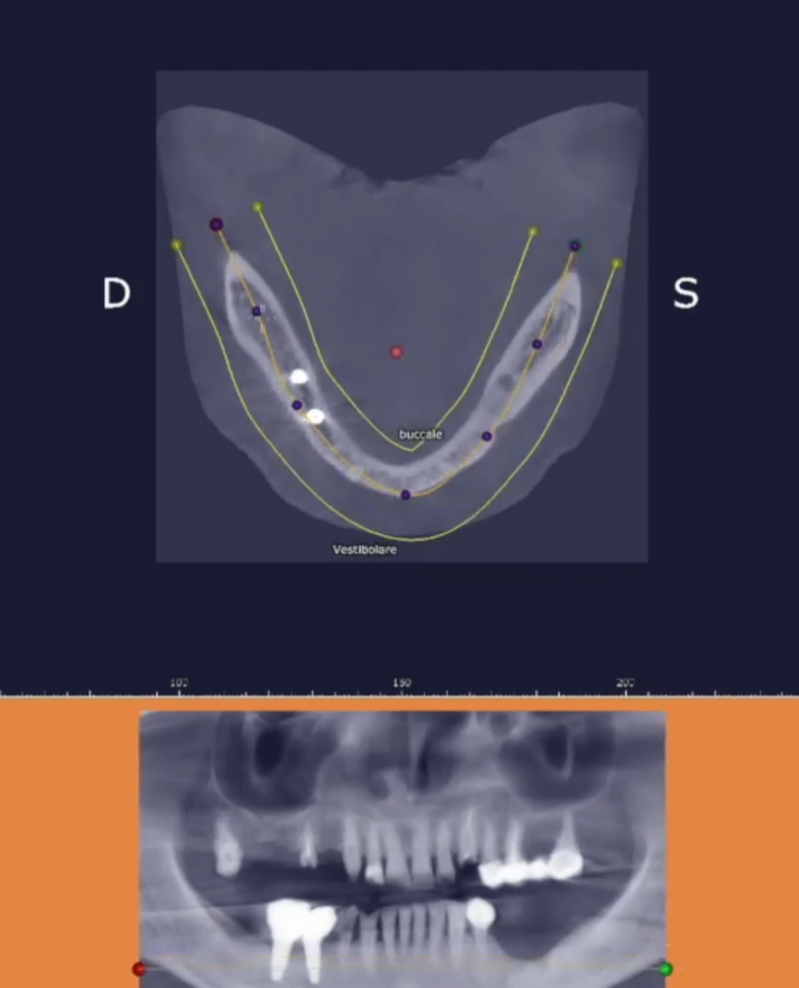 3D surgical guide cad cam design project