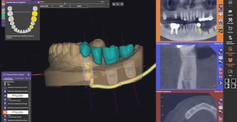 3D surgical guide cad cam design project