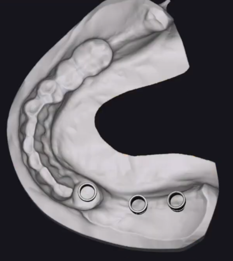 3D surgical guide cad cam design project