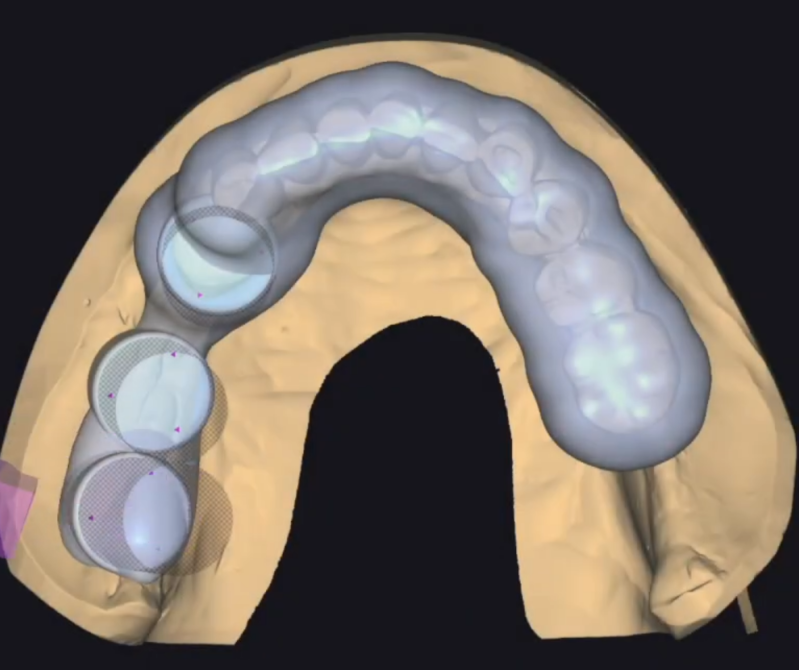 3D surgical guide cad cam design project