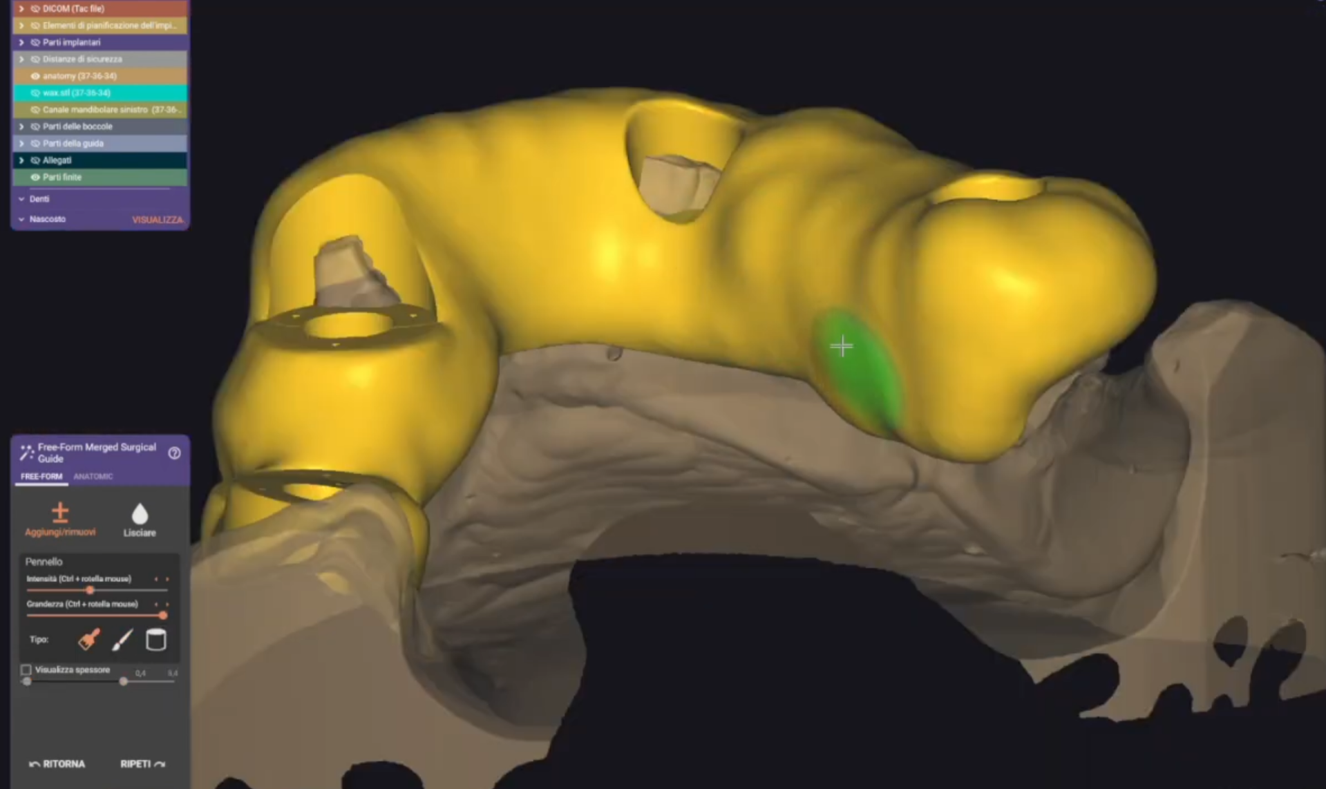 3D surgical guide cad cam design project