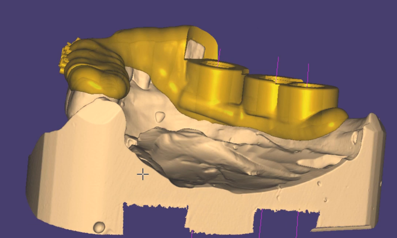 3D surgical guide cad cam design project