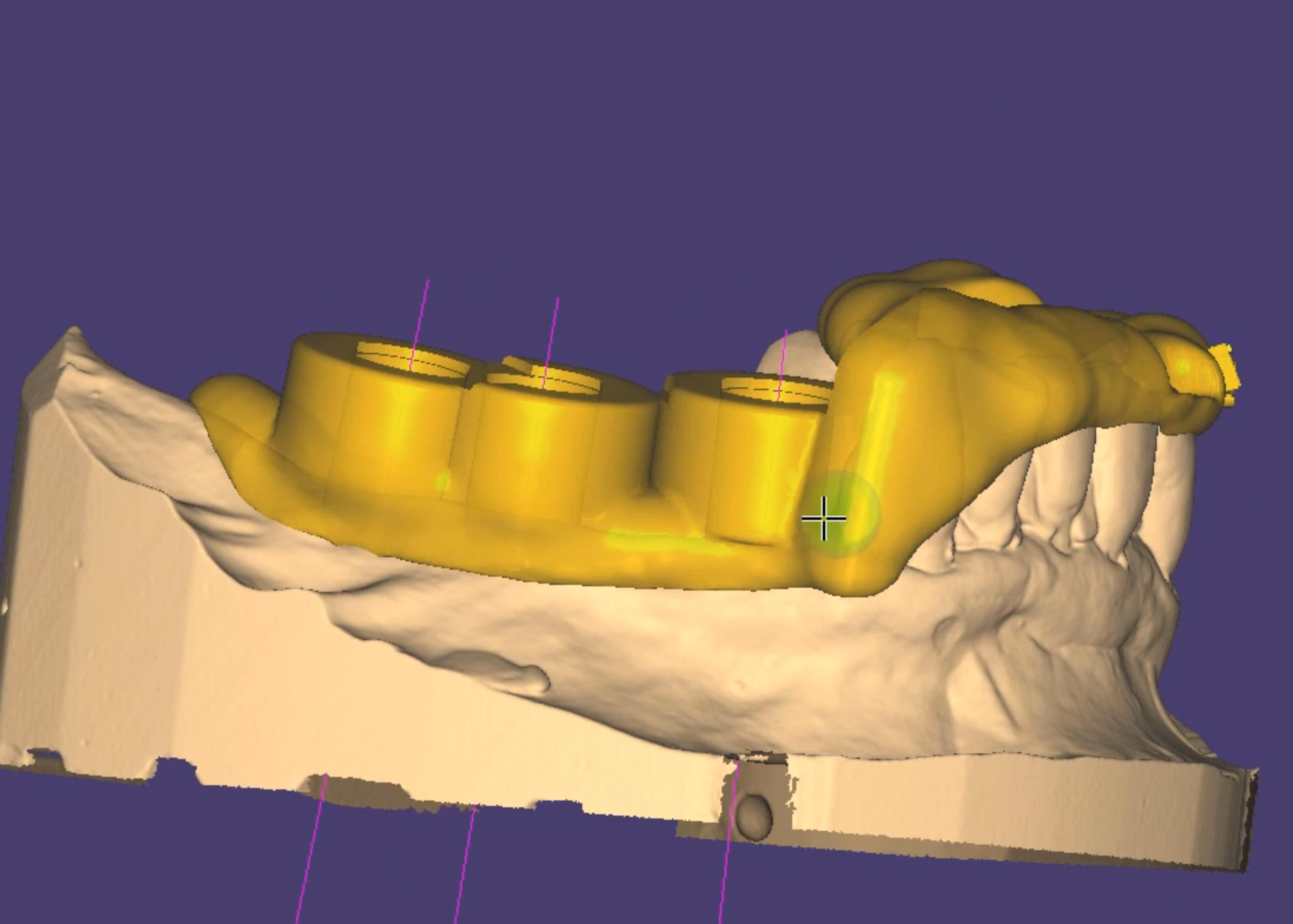 3D surgical guide cad cam design project