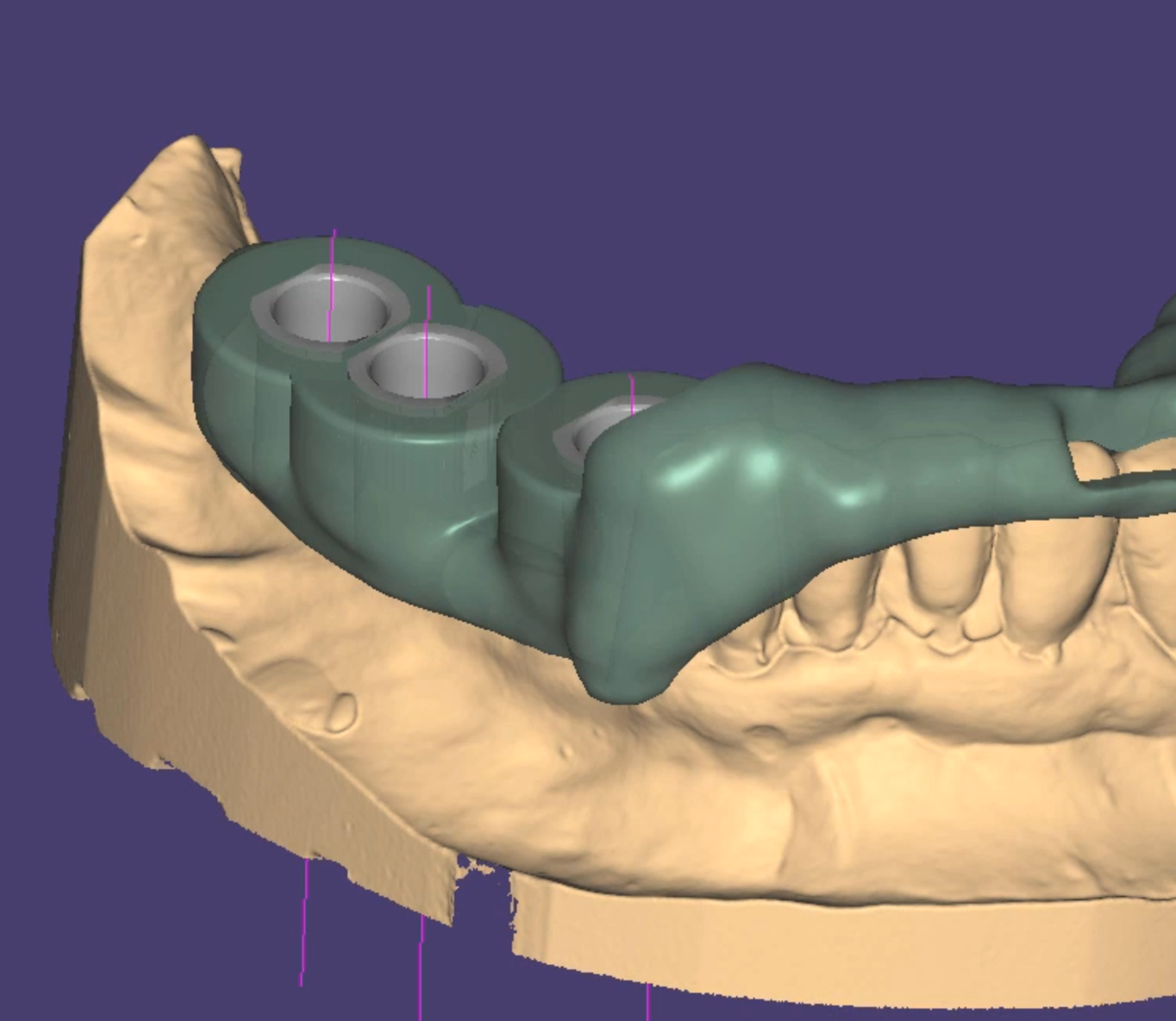 3D surgical guide cad cam design project