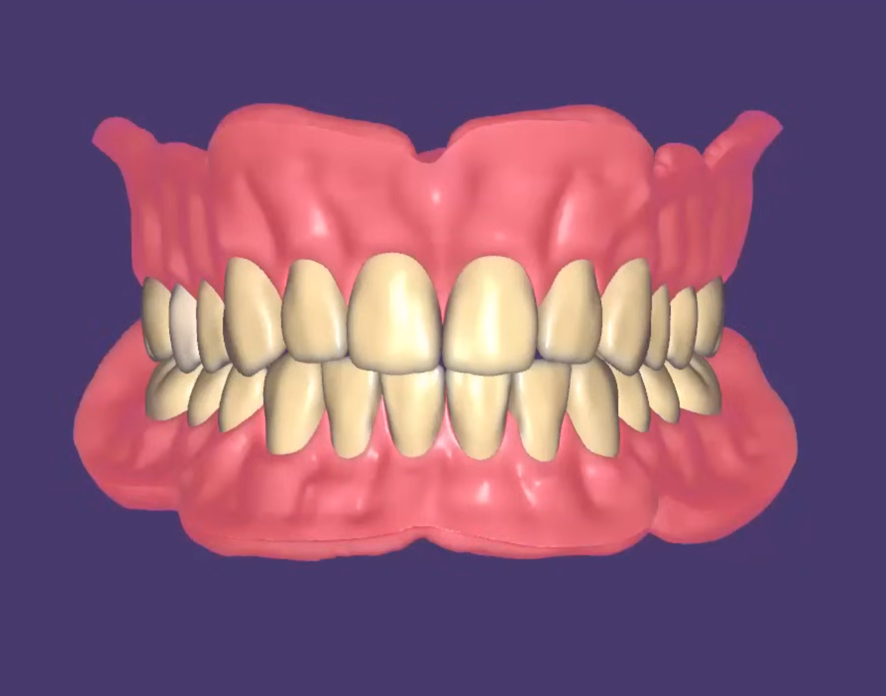 full denture 3D dental CAD design overnight turnaround CAD design for dental prosthetics