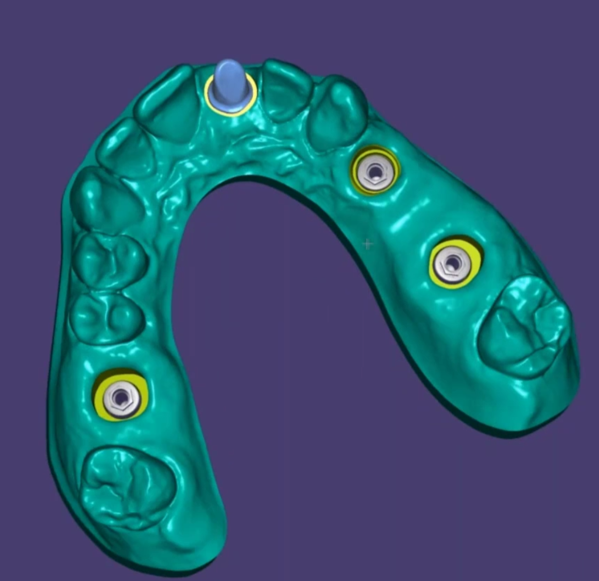 3D custom dental abutment on implant in upper jaw model CAD/CAM design for implant restorations