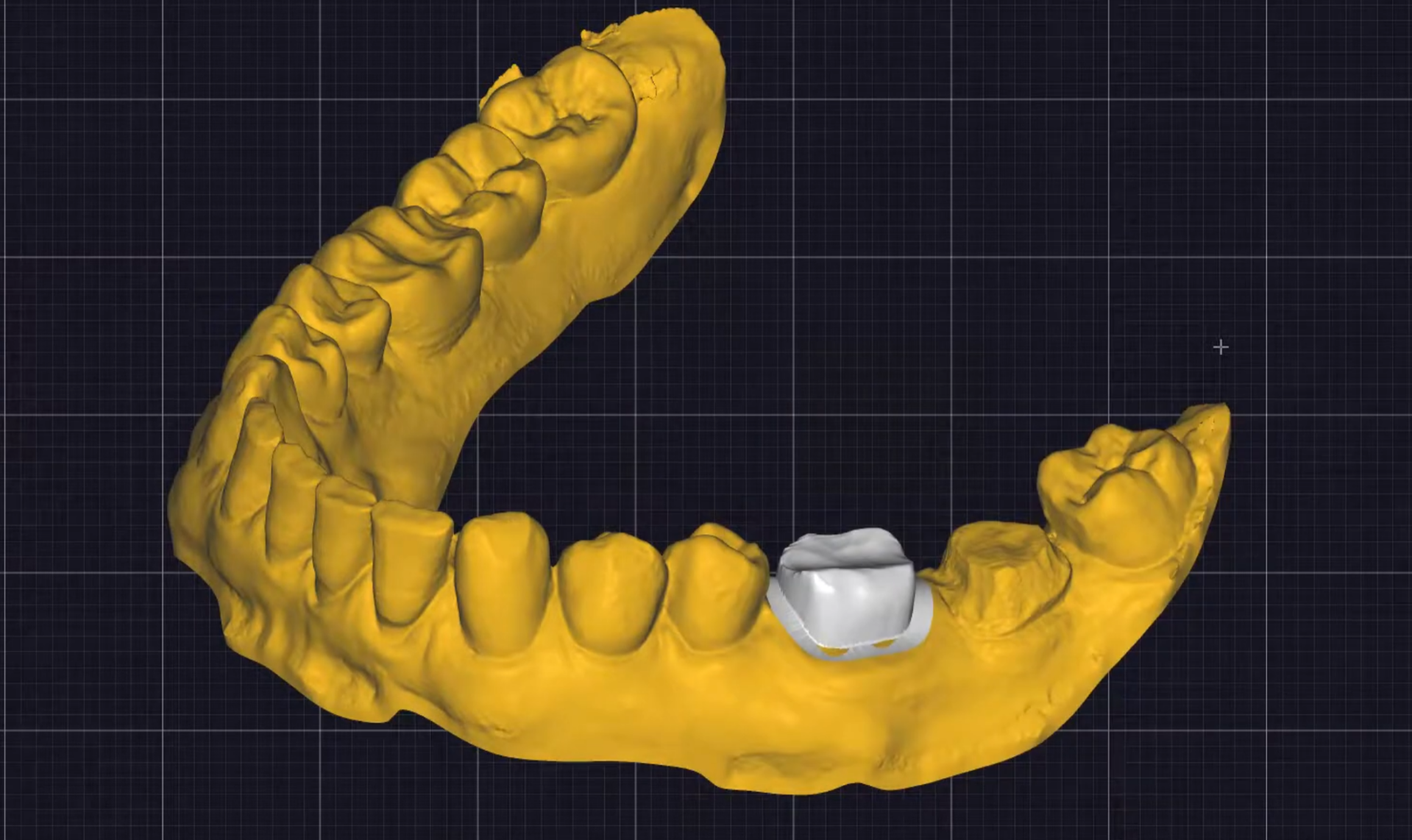 Prepared Teeth Design Exocad