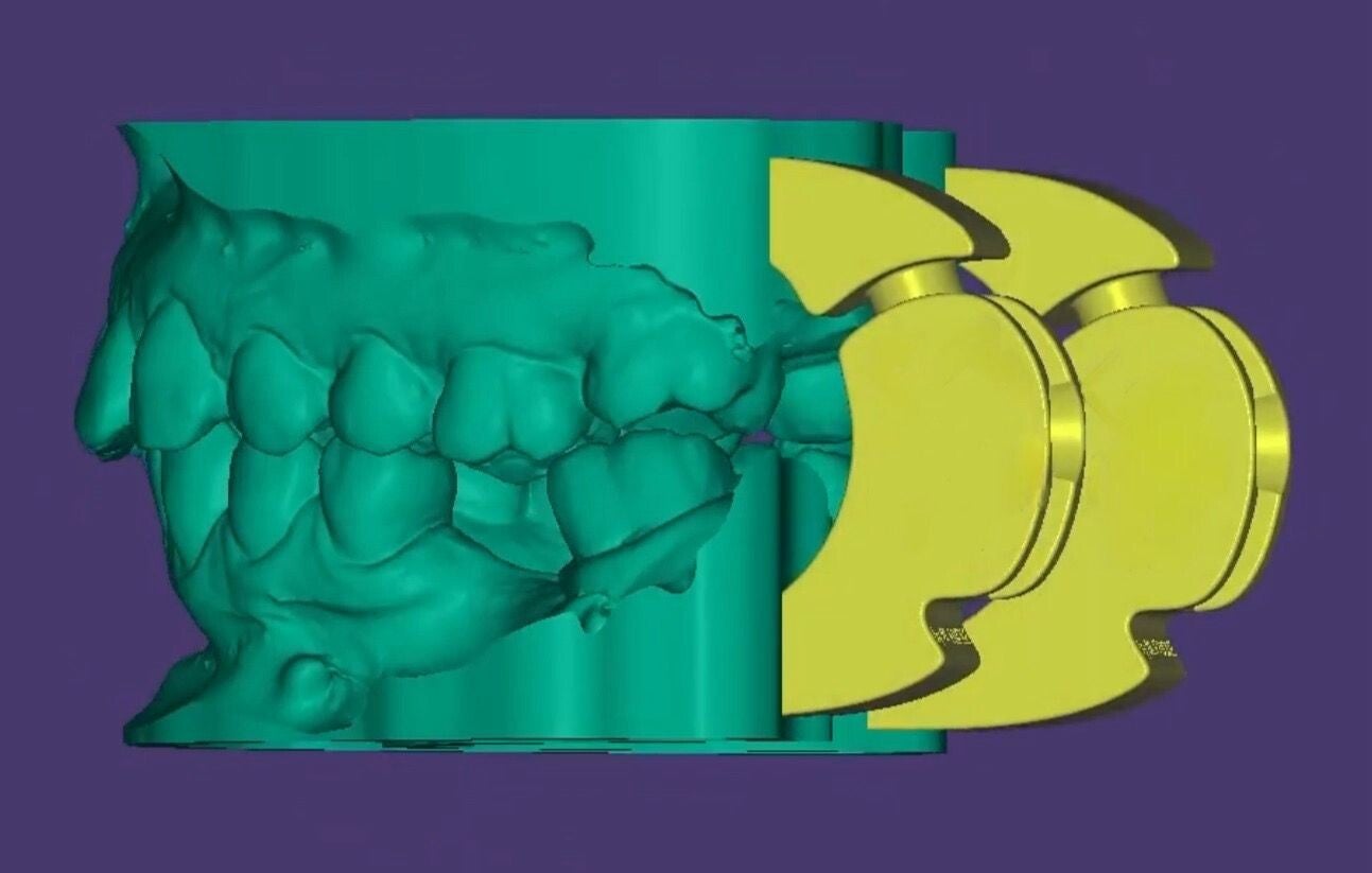Model Creator design exocad