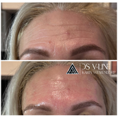 ds-v-line-hyathreads-mastertrainer-skinexperts-winterswijk-gelderland-ds-v-line-hyathreads-mastertrainer-skinexperts-winterswijk-gelderland1-standard.png