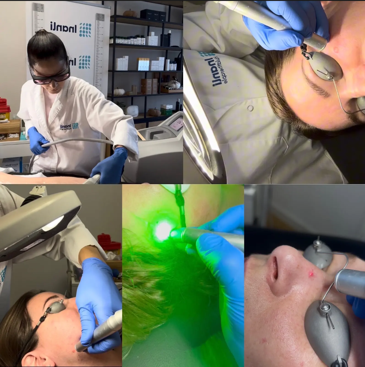 Laserbehandelingen