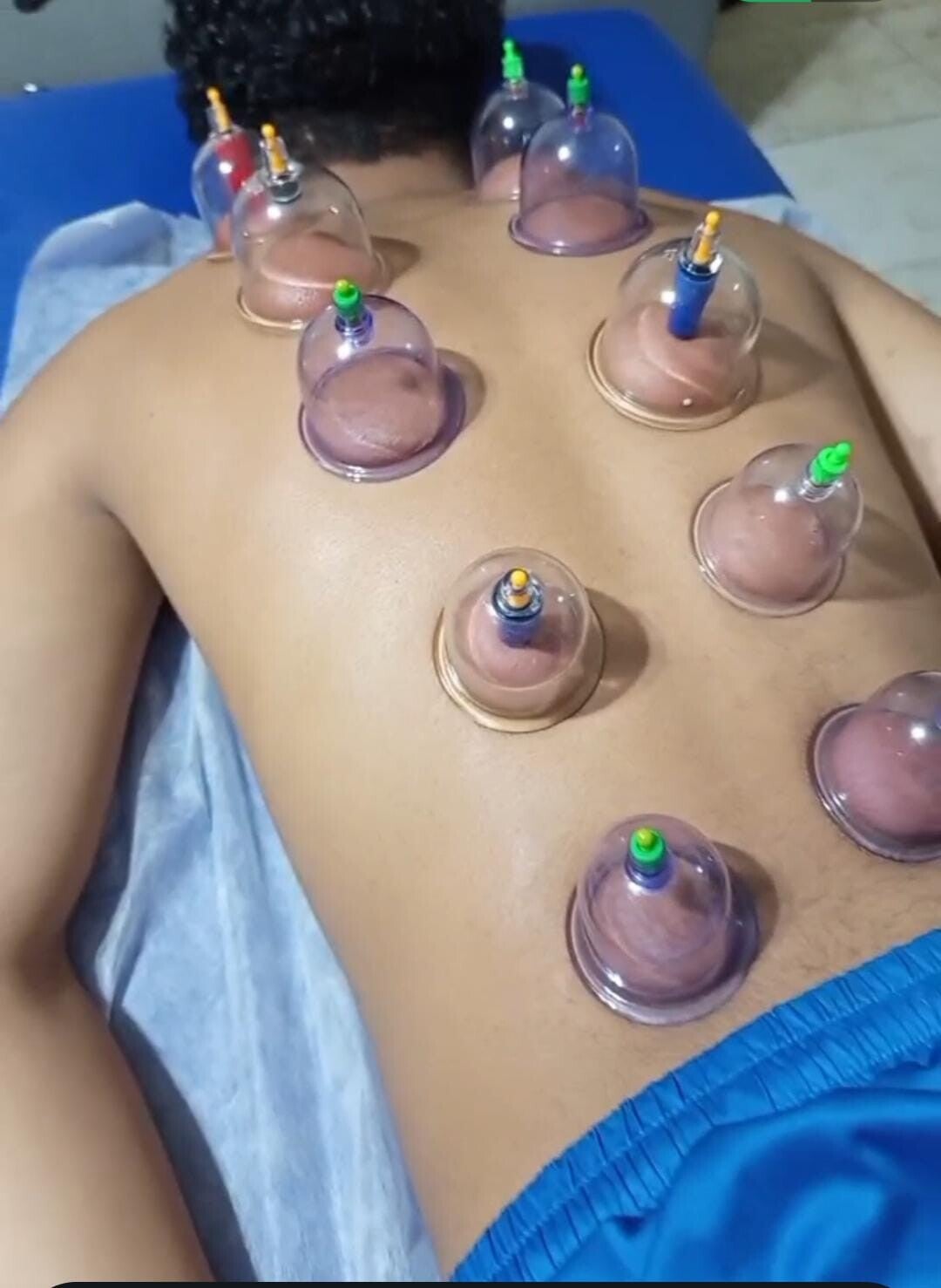 Ventosas Terapia