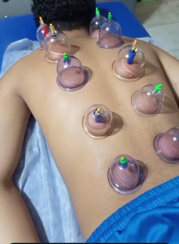 Ventosas Terapia