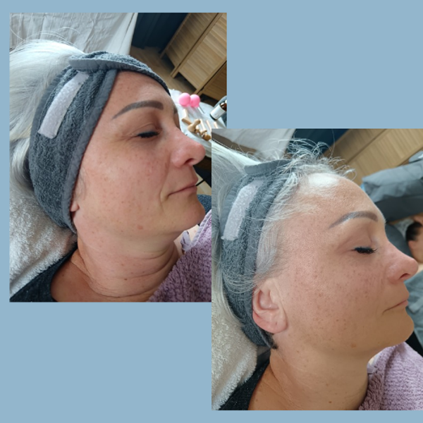FaceSculpt cure 3 séances