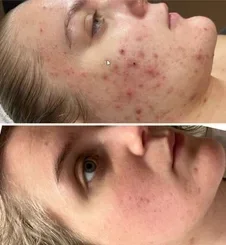 Voor en na acne behandeling bij Beautysalon Kimberley in Capelle aan den IJssel