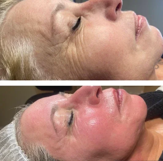 Voor en na resultaat van BDR huidverbetering – boven voor behandeling, onder na behandeling met zichtbaar verbeterde huidstructuur bij Beautysalon Kimberley in Capelle aan den IJssel 