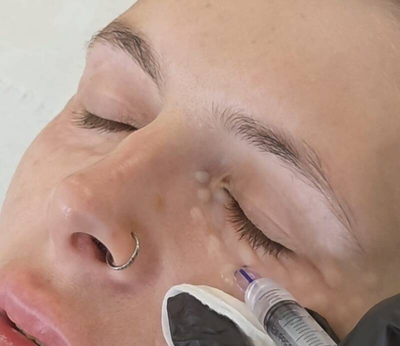 BeautifEYE papules 