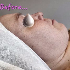 Glycolic acid & Lactic acid combo facial 