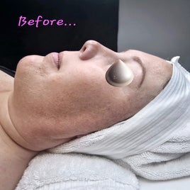 Microneedling facial 