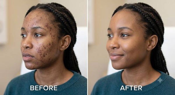 Professional Acne Clear Treatment Package