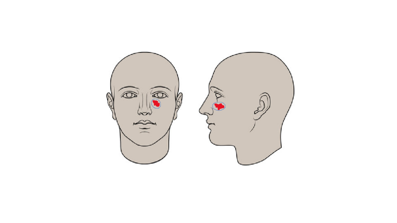 malle mka kaakchirurg huidtumoren kaakcorrectie antwerpen