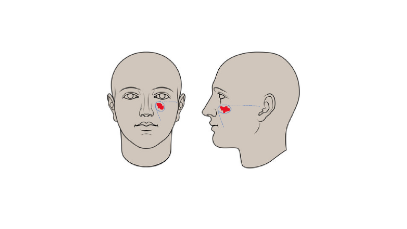 malle mka kaakchirurg huidtumoren kaakcorrectie antwerpen