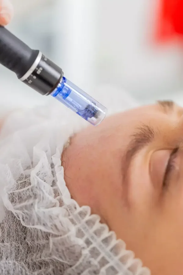 Microneedling Premium