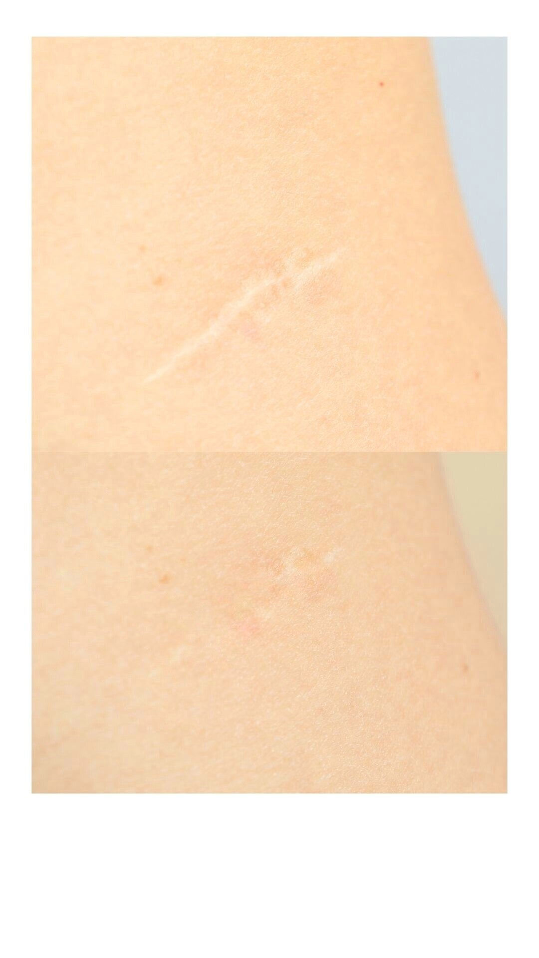 narbenpigmentation vorher sichtbare narbe, nachher der haut angepasst