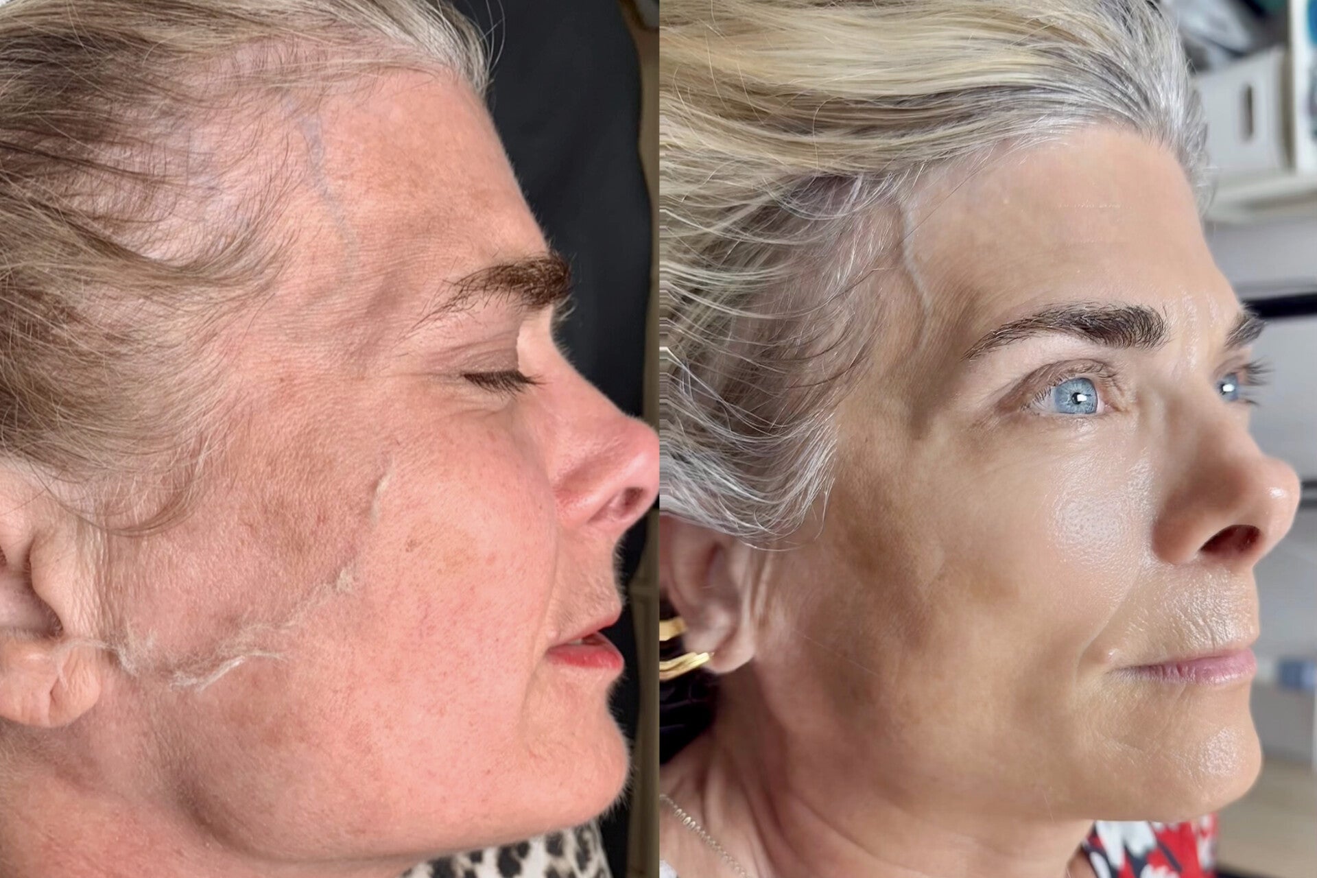 dermaplaning and skin care jpg