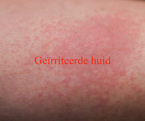geirriteerde huid