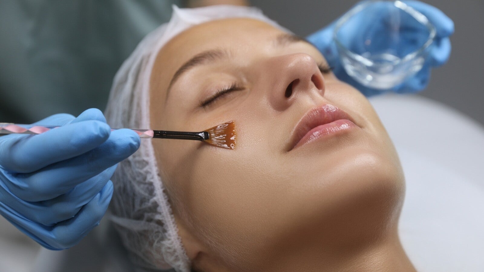 chemical peel