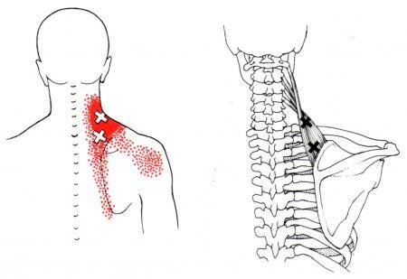 levator-scapulae-shoulder-pain-copy-copy-standard.jpg