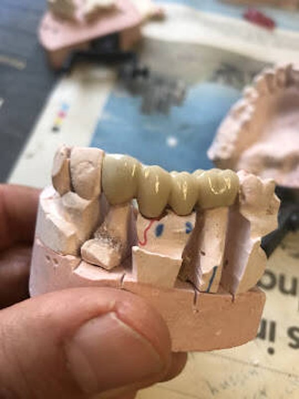 crown denture