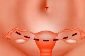 Histerectomía abierta.