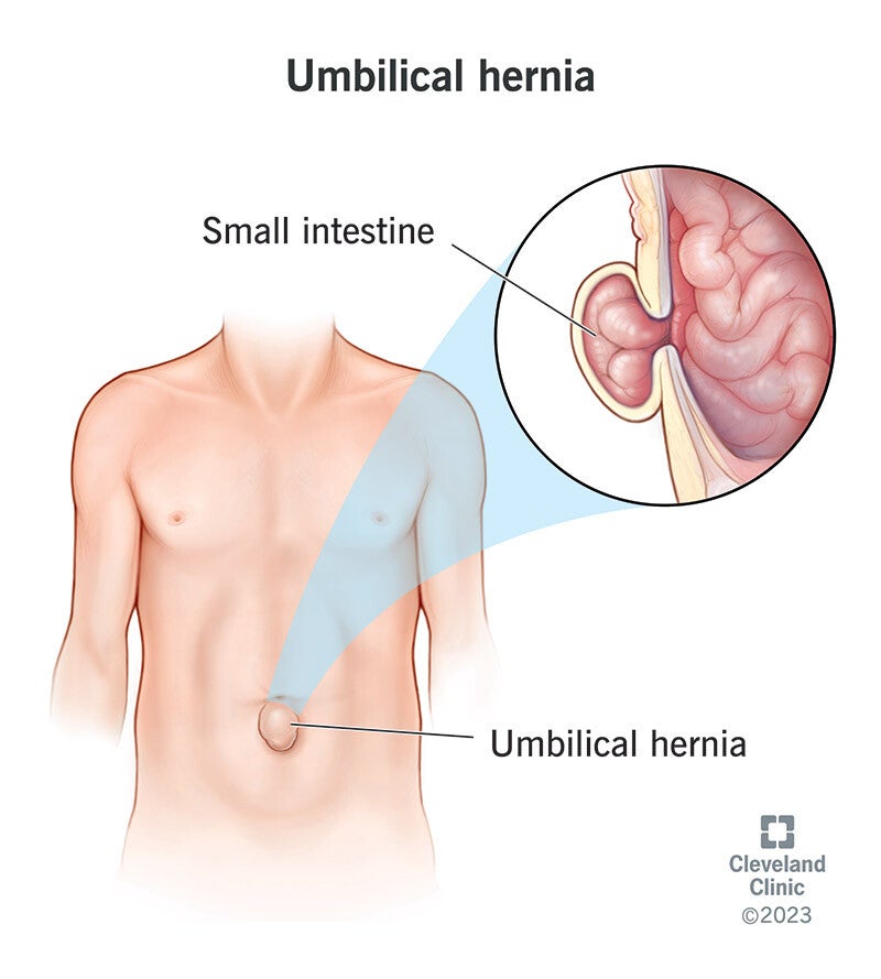 Cirugía de hernia umbilical