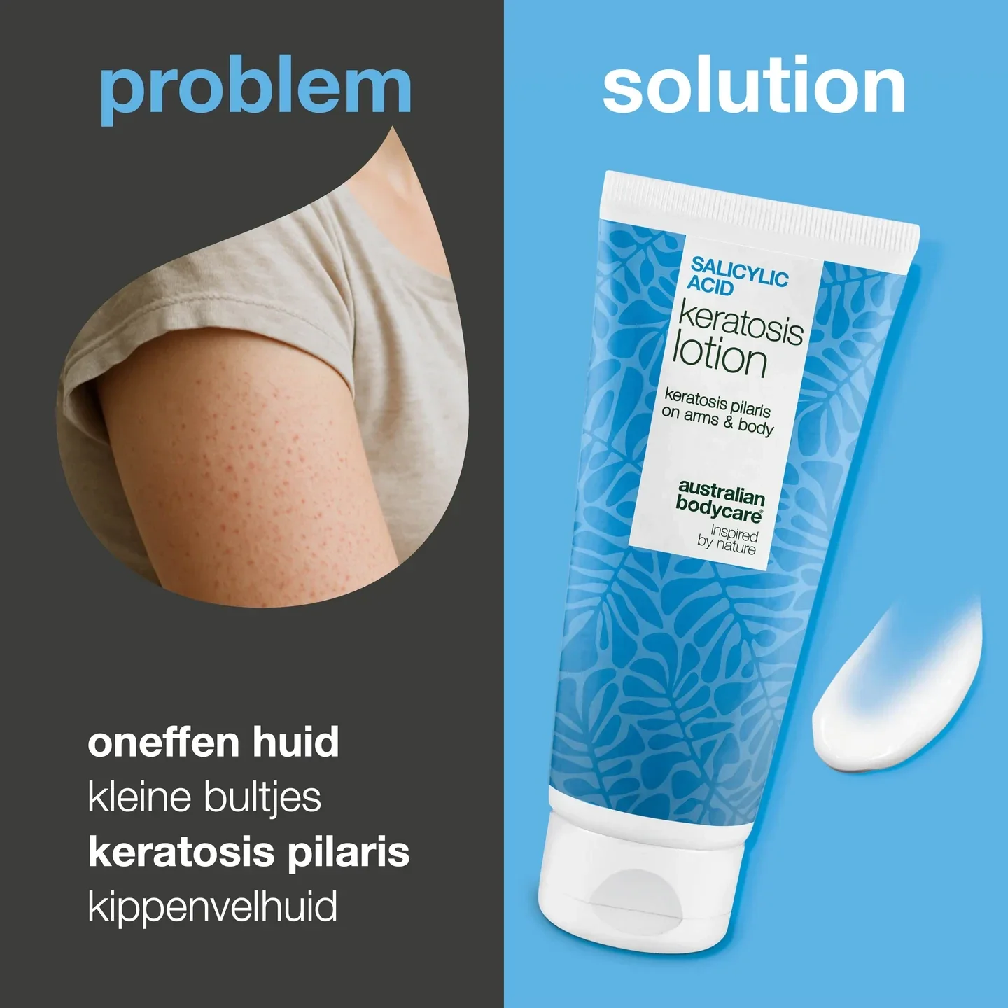 Body lotion bij keratosis pilaris en ruwe, bobbelige huid Body lotion voor keratosis pilaris en droge huid. Verzacht met salicylzuur, niacinamide en zink.