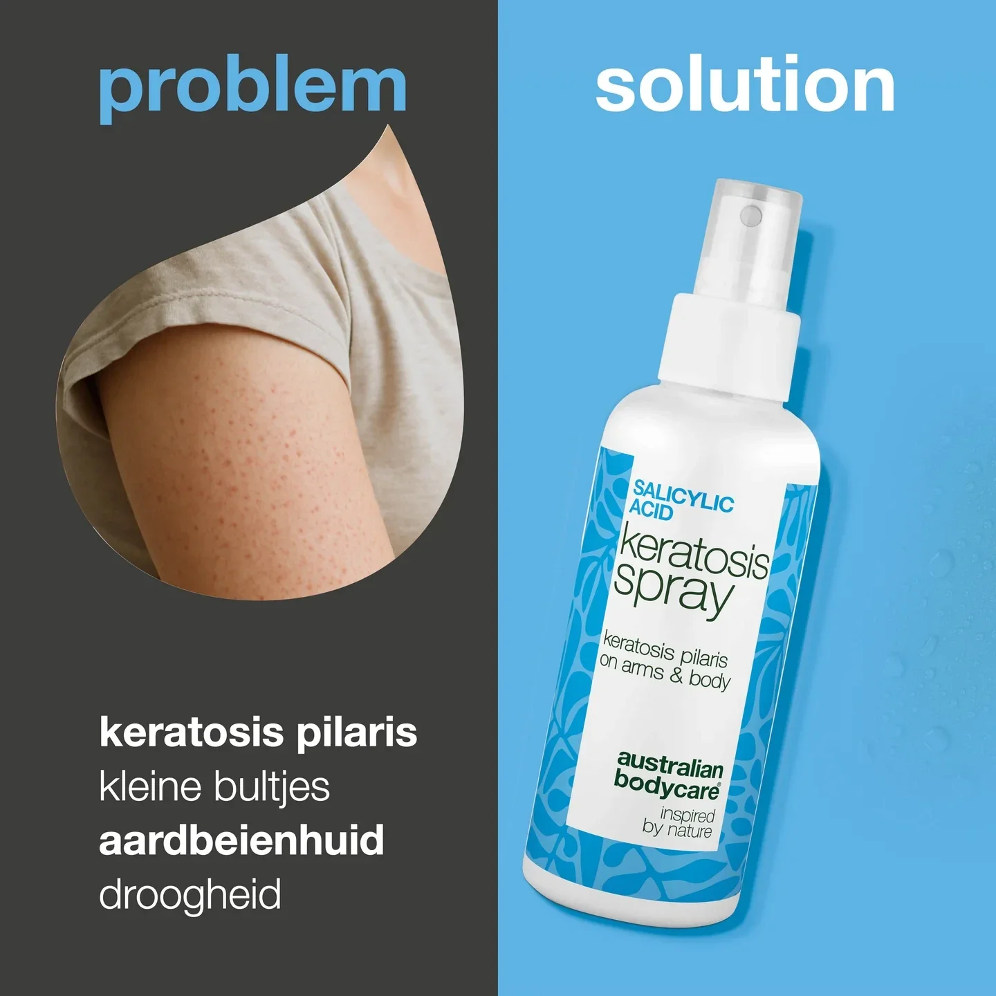 Keratosis pilaris spray tegen ruwe huid en bultjes Keratosis pilaris spray vermindert ruwe bultjes en maakt de huid glad. Bevat salicylzuur voor diepe exfoliatie.