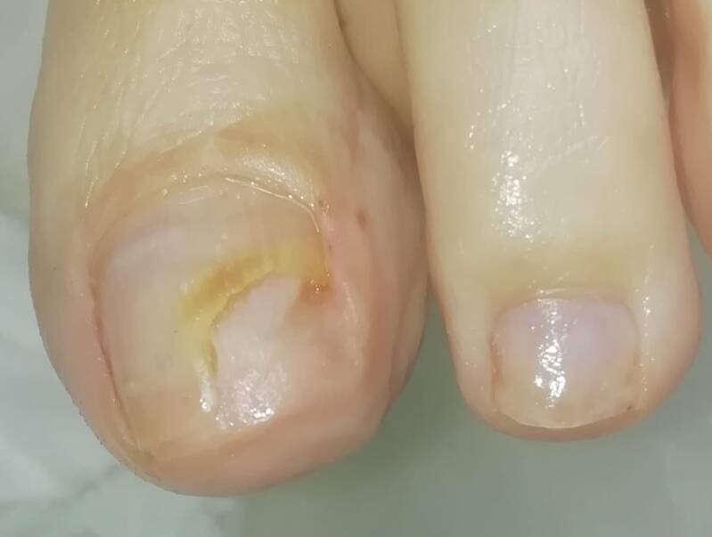 Voorbeeld van een beschadigde teennagel die door medisch pedicure Samira van der Mee uit Arnhem is behandeld.