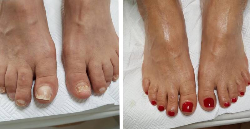 Voorbeeld van een nagelreparatie door medisch pedicure Samira van der Mee uit Arnhem. De nagel is met behulp van polyacryl herstelt en ziet er weer esthetisch en goed verzorgd uit.