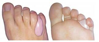 Voorbeeld van een orthese geplaatst op de voeten van een client vanmedisch pedicure Samira van der Mee. Eigenaar van pedicure praktijk Samira in Arnhem Zuid