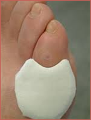 Voorbeeld van een antidrukbehandeling op een voet gemaakt door medisch pedicure Samira van der Mee, eigenaar van pedicure praktijk Samira in Arnhem-Zuid