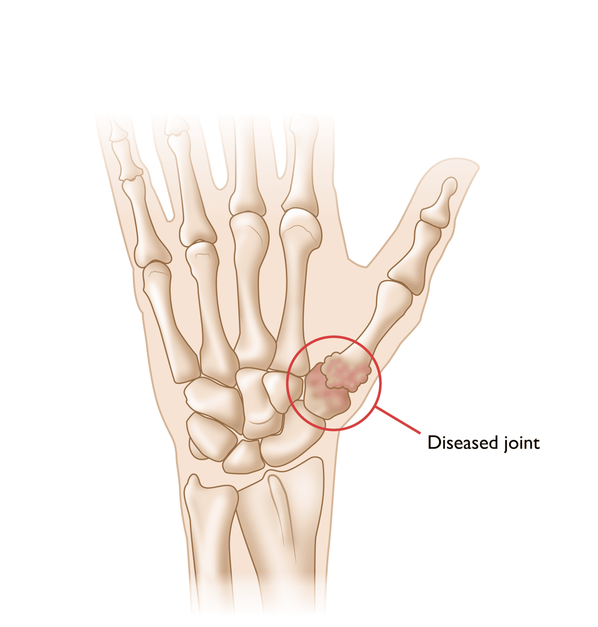 Thumb Arthritis and CMC Suspensionplasty / Elbow/Wrist/Hand ...