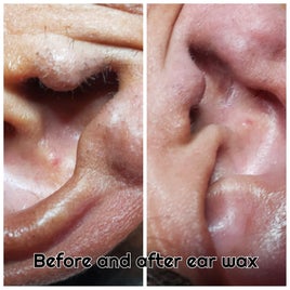 ear-waxing-standard.jpg