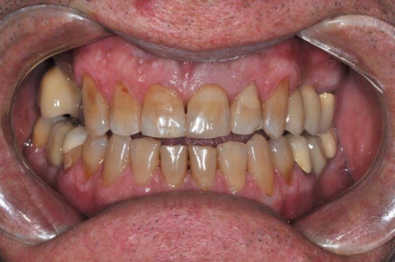 21 zircone stratifiée