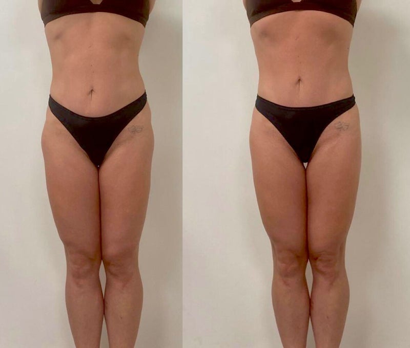 anti-cellulite massage effecten, afslanking massage, lymphedrainage, brazilian sculpting massage effecten, voor en na lymphatic drainage massage