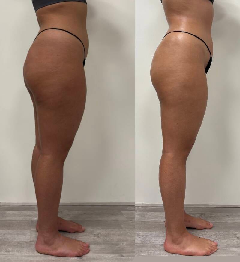 Vacuslim 48 results of one treatment. Get rid of cellulite and re-shape your body without invasive procedures.